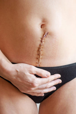 La césarienne : une naissance unique, une force à célébrer